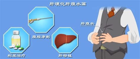 轻度肚子腹水图片