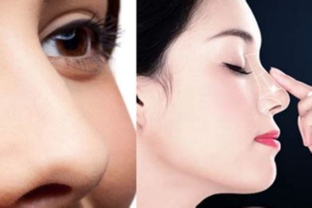 【图】鼻子整形修复时间需要多久 正确护理才能拥有完美鼻型_鼻子整形_伊秀美容网|yxlady.com
