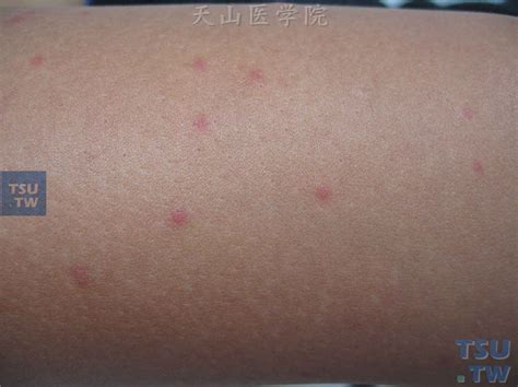 蚊虫叮咬（mosquito bite） - 皮肤病学 - 天山医学院
