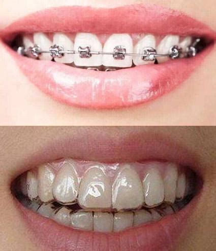 牙齿矫正如何选择牙套？三大牙套类型盘点！ - 知乎