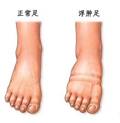 脚肿图片