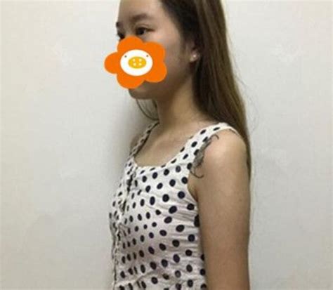 年轻人喜欢的胸型 巴诺巴奇水滴形胸部整形备受关注_湖南频道_凤凰网