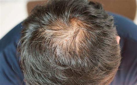 常见的脱发类型有哪些？应该怎样治疗？