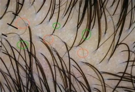 毛囊坏死前的求救信号你知道吗？大麦植发都帮您整理出来了_-泡泡网