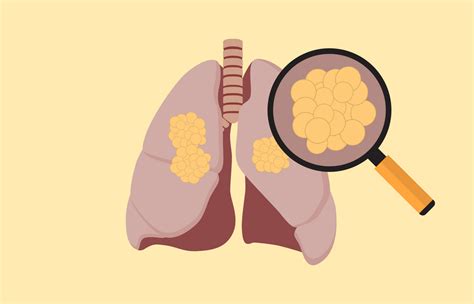 为什么肺癌一发现就是晚期？肺癌能在早期发现吗？_肿瘤_医生在线
