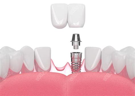 资阳口腔医院收费标准,含资阳种植牙/矫正牙/补牙/洗牙价格,种植牙-8682赴韩整形网