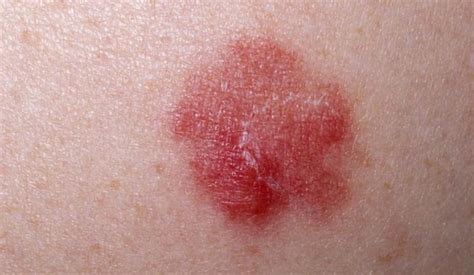 梅毒小红点早期图 小心，别傻乎乎以为这是过敏皮炎，还可能是可怕的梅毒疹！ | 红五百科
