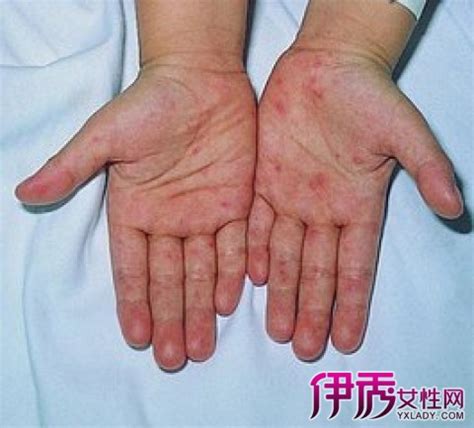 药物过敏皮疹图片