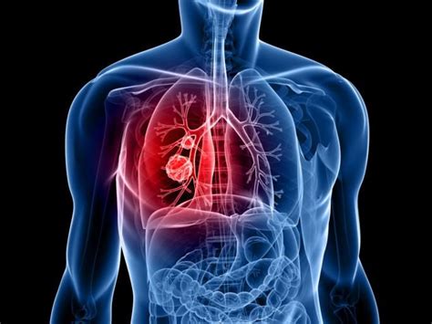 肺癌致病因素有哪“五气”？注重预防保持肺部健康 - 青岛新闻网