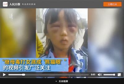 女孩被继母打成“熊猫眼”-新闻中心-温州网