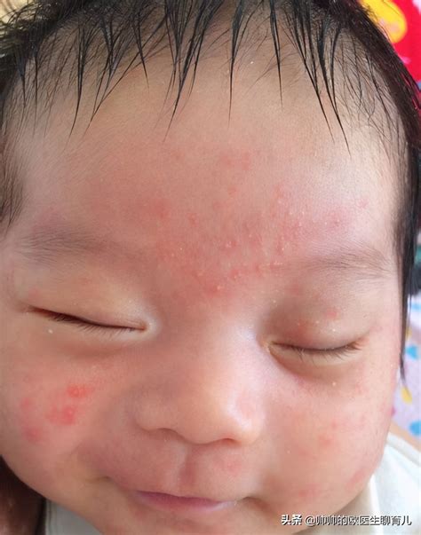 奶疹和湿疹的区别图片对比图片(奶藓？湿疹？专家教您一眼判断) | 说明书网