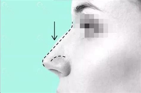 宽鼻矫正失败多久可以修复-欣美整形网
