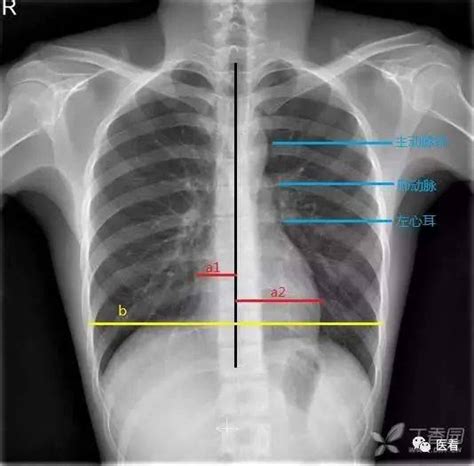 临床执业实践技能模拟习题：X线-心脏增大（二尖瓣型、主动脉型和普大型）