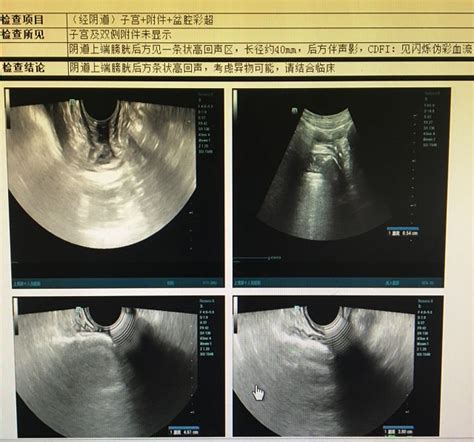 关于女性生殖器官畸形统一命名和定义的中国专家共识_子宫疾病_妇科微创网