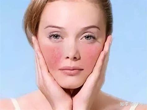 U牌：为什么皮肤会过敏，如何预防护肤品过敏 - 知乎