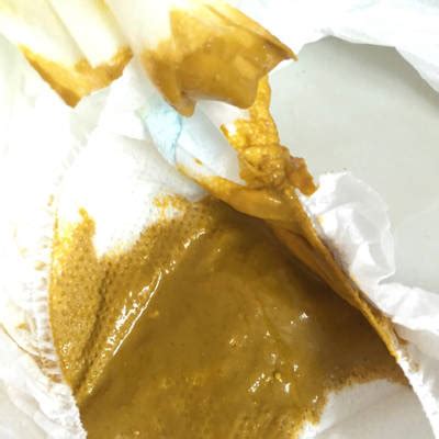 果酱样大便图片