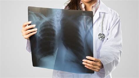 肺结核患者的健康指导和护理-复禾疾病百科