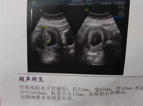 孕囊图片