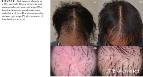 针对雄激素性脱发（AGA）患者的RCP疗法 - 知乎