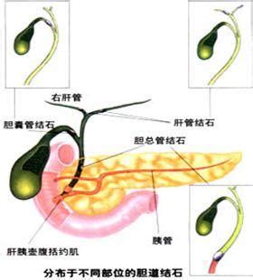 急性胆管炎和急性梗阻性化脓性胆管炎的区别_39问医生_39健康网