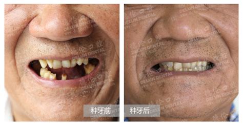 7旬高龄老人为精工种植牙点赞 好牙享好口福——广州德伦口腔
