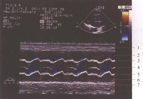 图14-8 心底波群 (4区，M型超声心动图)-外科学-医学