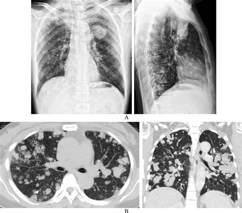 影像入门必备：这 6 种胸部 CT 征象最常见