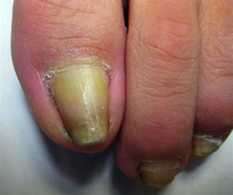 灰指甲会导致指甲脱落吗 灰指甲的症状你知道多少-京东健康
