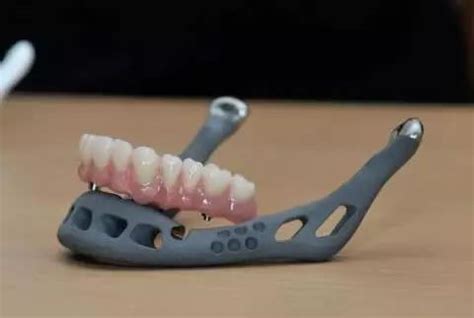量身定制：3D打印应用于骨科植入物 - 中国核技术网