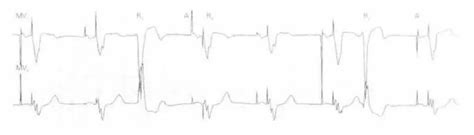 心脏起搏器的发展与变迁_应用_导线_患者