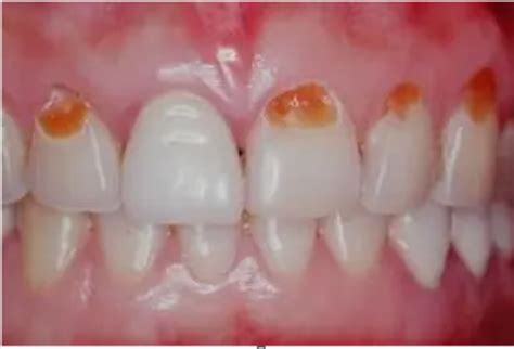 牙髓炎可以自愈吗？牙髓炎牙龈炎牙周炎有什么区别？关于牙髓炎你需要知道的_口腔健康_什么值得买
