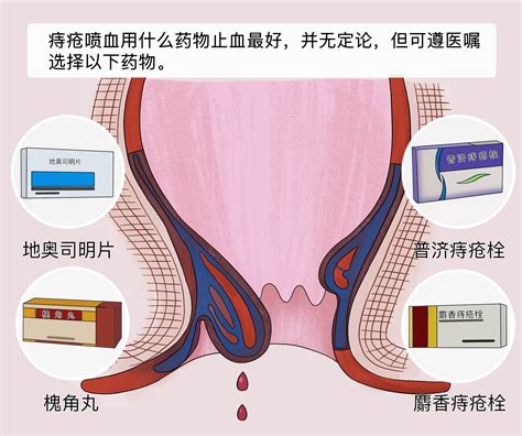 痔疮什么样的图片