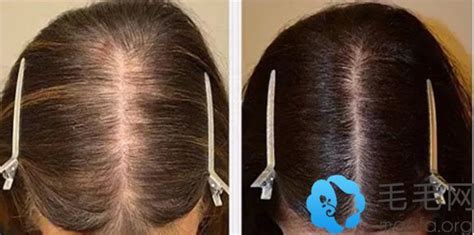 女生头顶发缝宽怎么办 想恢复是植发好还是药物止脱好 - 热点资讯 - 毛毛网