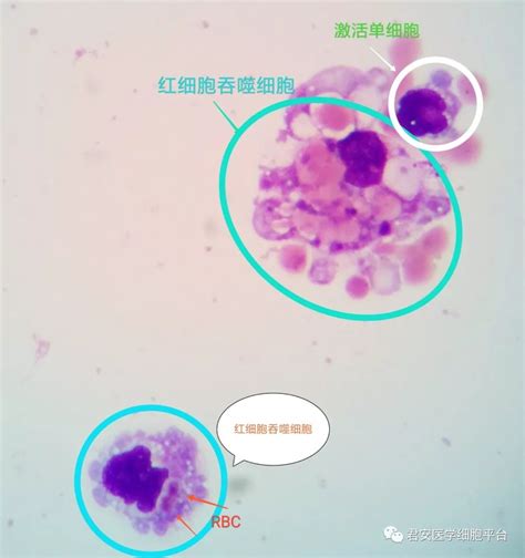 噬血细胞综合征-医学细胞彩图-医学