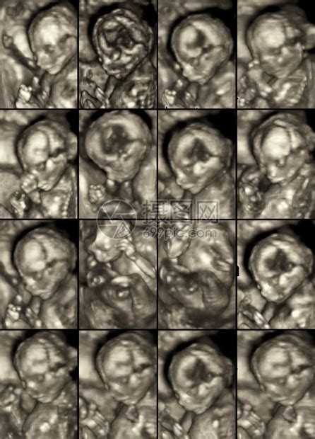 对怀孕4个月的女胎儿进行3D超声异常扫描的16幅医高清图片下载-正版图片507303857-摄图网