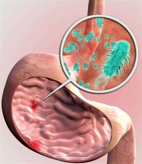 提醒：感染上幽门螺杆菌，可能会有这5个症状，大多数人都忽略了|幽门螺杆菌|胃泌素|症状|感染|口臭|嗳气|胃癌|反酸|胃酸|-健康界