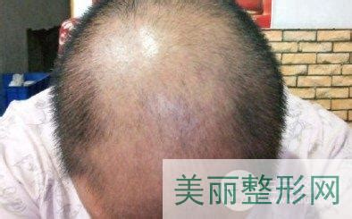 科学家：补充一种益生菌或能避免脱发并拯救“秃头” - 知乎