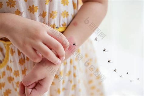 小女孩的皮疹过敏手臂因蚊子叮咬而发痒图片-包图网企业站