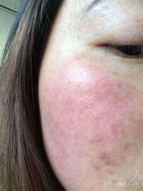 【图】揭秘脸起皮是怎么回事 快速了解有效预防脱皮(2)_脸起皮是怎么回事_伊秀美容网|yxlady.com