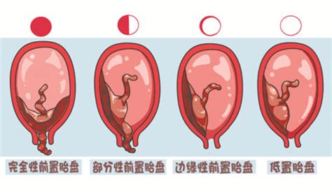 什么是胎盘前置？ 它对妊娠和分娩有何影响？-信息日报-大江网（中国江西网）