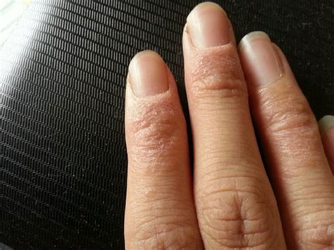 手指湿疹症状图片 (60)_有来医生