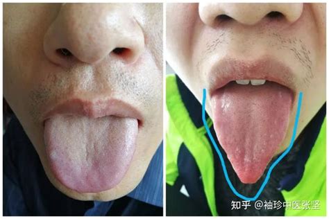 正常舌头的图片