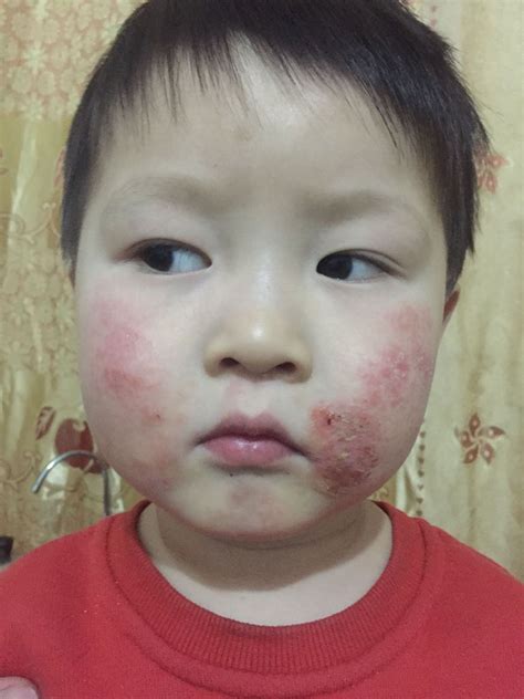 婴儿脸上米粒小疙瘩图_粟粒疹与湿疹图片图_微信公众号文章