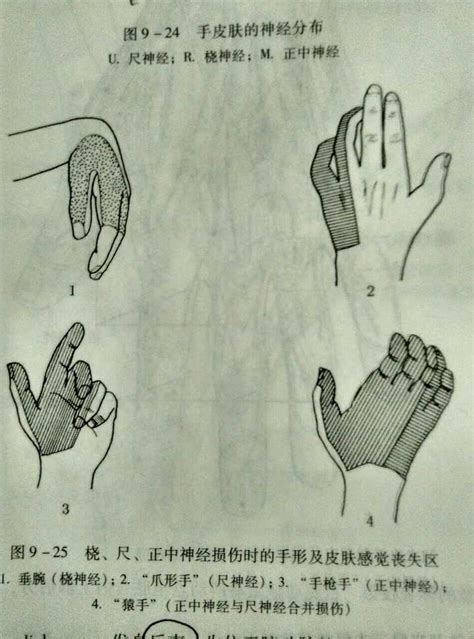 猿形手和爪形手区别,猿手爪形手区别,爪形手和猿形手图片(第8页)_大山谷图库