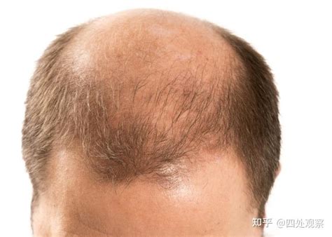 科学家成功利用诱导多能干细胞技术再生毛囊解决脱发问题 - 知乎
