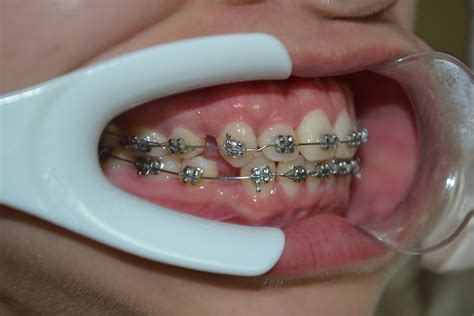牙齿的对比图片-美白前后的女性牙齿素材-高清图片-摄影照片-寻图免费打包下载