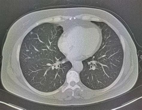 正常肺图片ct,正常肺t片图片区分,正常t肺图片大全_大山谷图库
