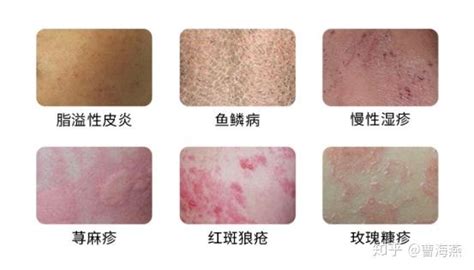 冬季皮肤瘙痒患者增多，如何快速鉴别诊断？