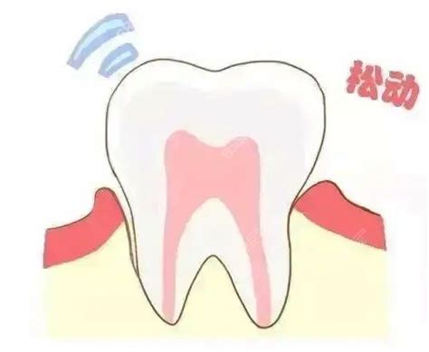 牙齿松动有办法加固吗？_牙齿松动-深圳爱康健口腔医院