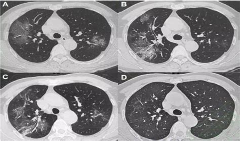 新型肺炎疫情期间，若肺出现问题了，身体常见这4种表现，别大意
